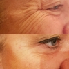 dawn botox Feb 2018