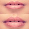 lipfillers