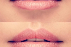 lipfillers